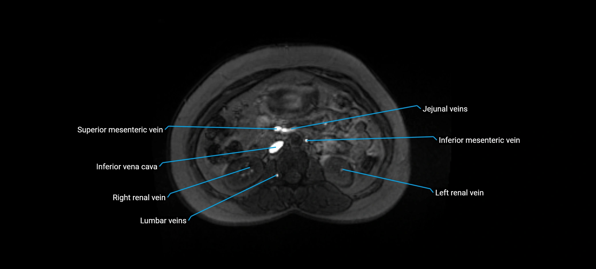 MRV abdomen pelvis & lower limb axial cross sectional anatomy labelled MRI image 76 (1).webp